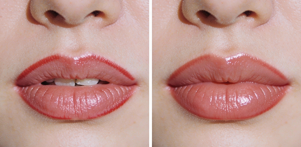 What to Expect Before and After Lip Filler Treatmen