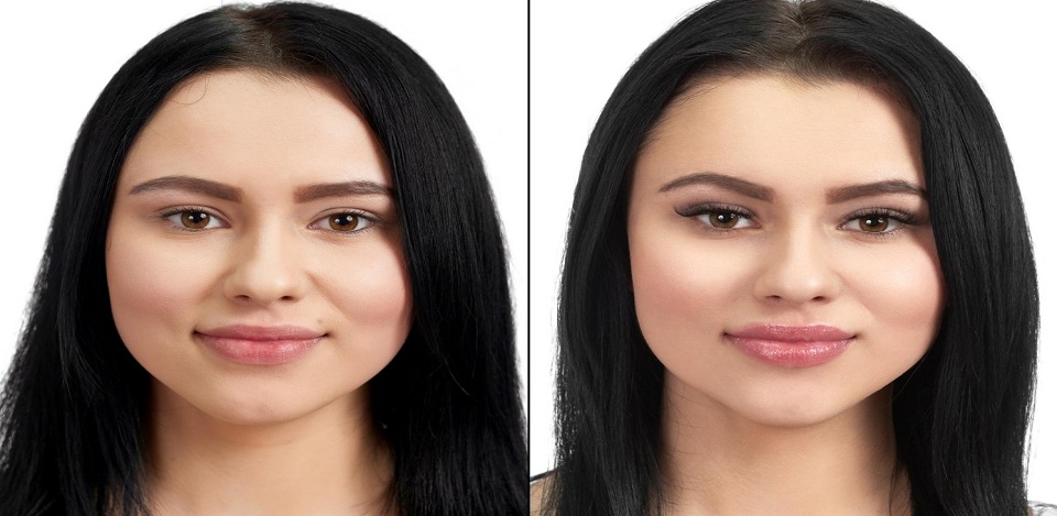 Juvéderm Versus Restylane