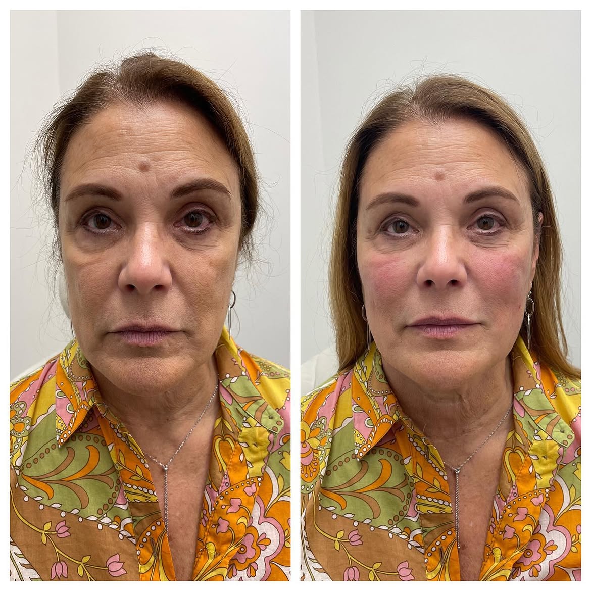 Before and after treatment photo 3