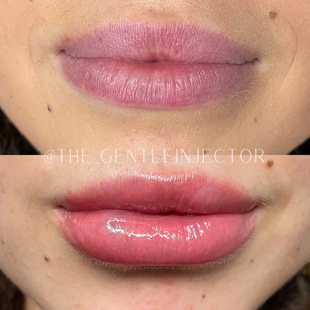 Before and after treatment photo 9
