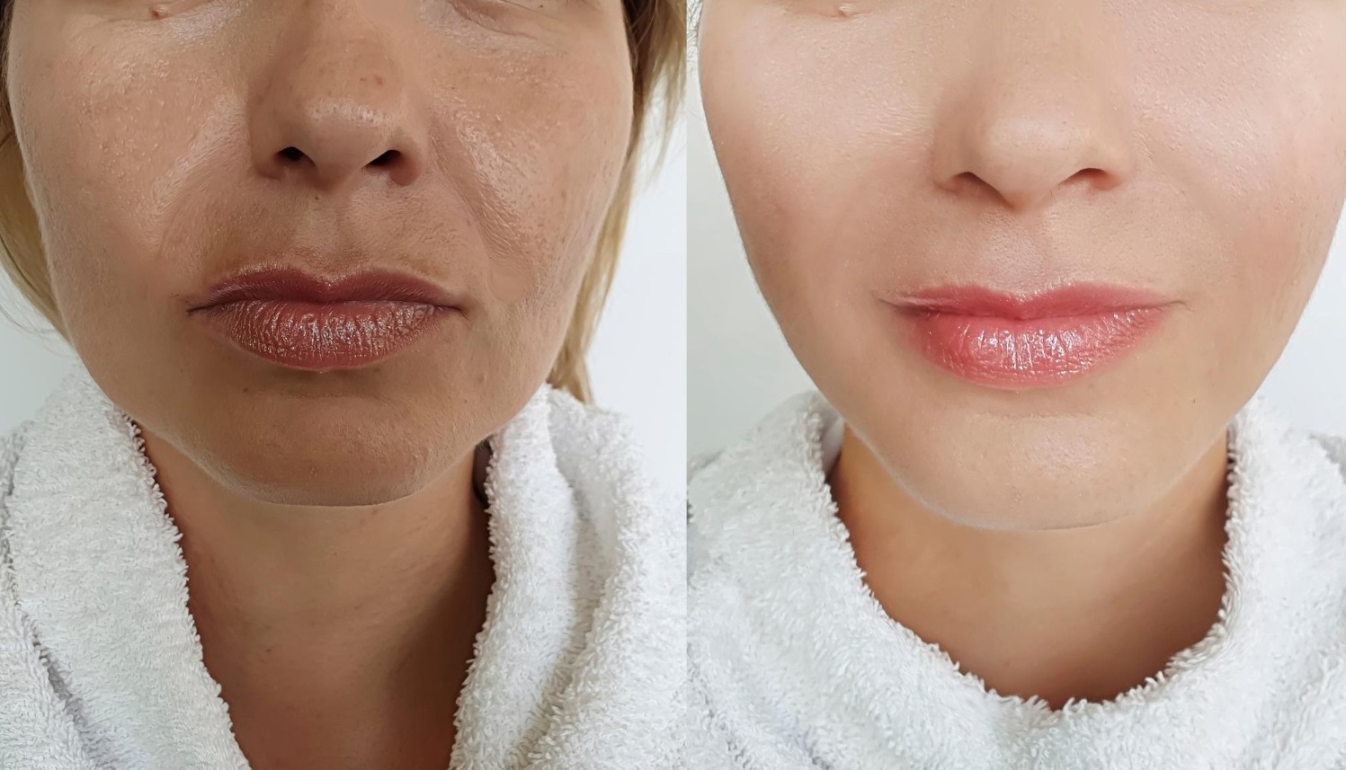 During and After hyaluronic acid fillers Treatment